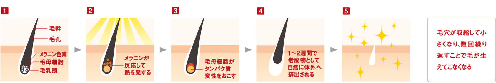 フラッシュ式美肌脱毛は施術後1~2週間で自然に抜け落ちます!
